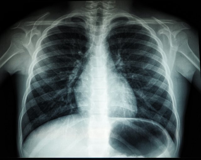Mesothelioma lawsuit